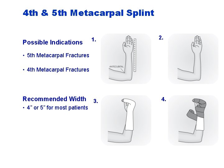 4 th & 5 th Metacarpal Splint Possible Indications 1. 2. • 5 th