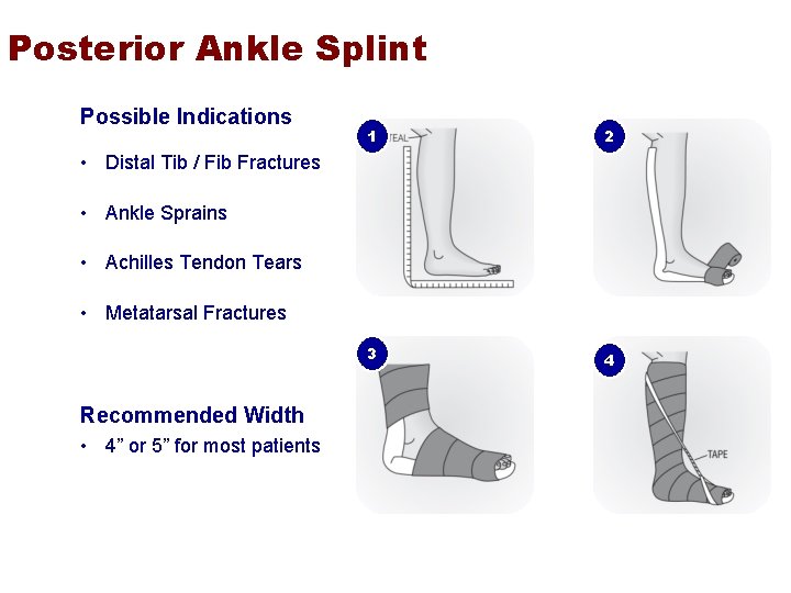 Posterior Ankle Splint Possible Indications 1 2 3 4 • Distal Tib / Fib