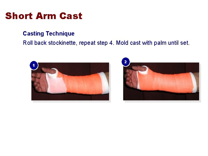 Short Arm Casting Technique Roll back stockinette, repeat step 4. Mold cast with palm