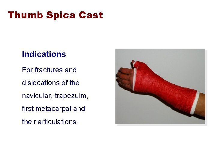 Thumb Spica Cast Indications For fractures and dislocations of the navicular, trapezuim, first metacarpal