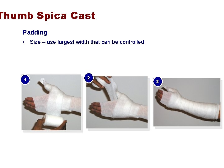 Thumb Spica Cast Padding • Size – use largest width that can be controlled.