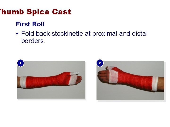 Thumb Spica Cast First Roll • Fold back stockinette at proximal and distal borders.