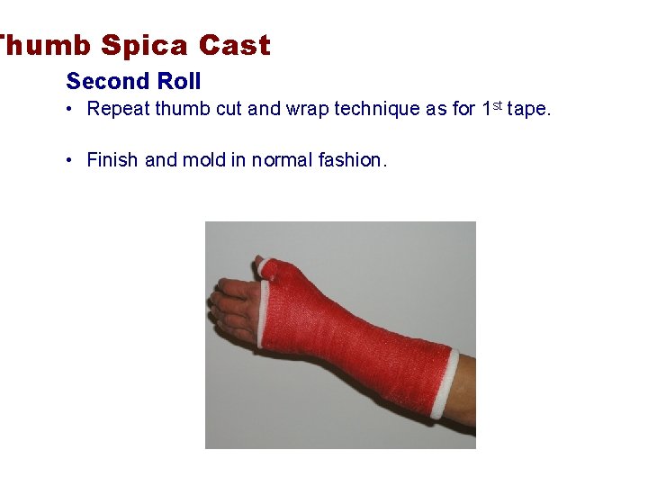 Thumb Spica Cast Second Roll • Repeat thumb cut and wrap technique as for