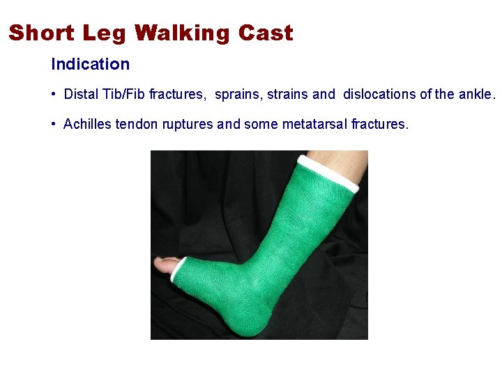 Short Leg Walking Cast Indication • Distal Tib/Fib fractures, sprains, strains and dislocations of