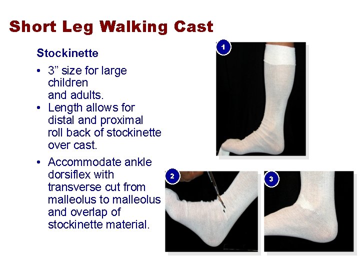 Short Leg Walking Cast 1 Stockinette • 3” size for large children and adults.