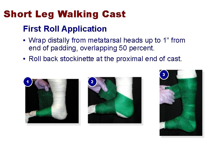 Short Leg Walking Cast First Roll Application • Wrap distally from metatarsal heads up