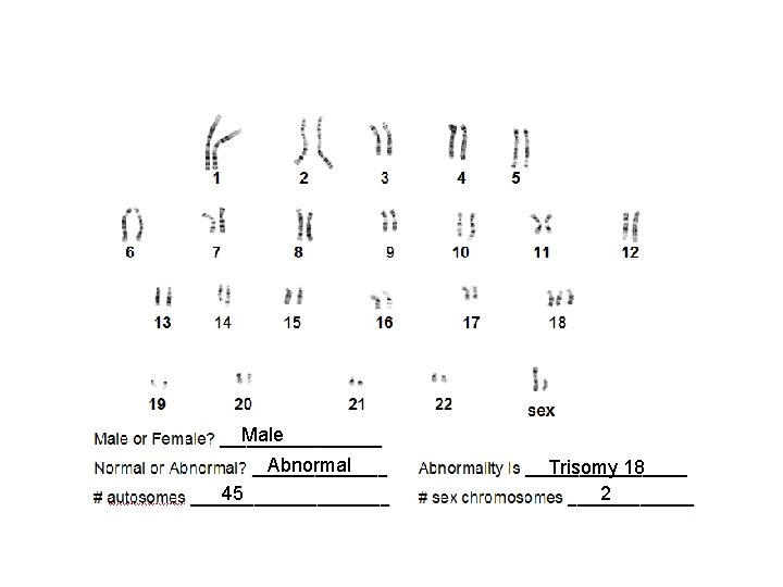 Male Abnormal 45 Trisomy 18 2 