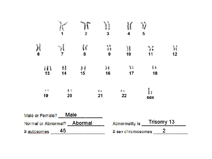 Male Abormal 45 Trisomy 13 2 
