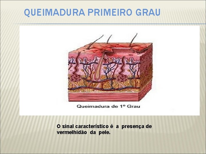 QUEIMADURA PRIMEIRO GRAU O sinal característico é a presença de vermelhidão da pele. 