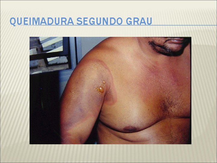 QUEIMADURA SEGUNDO GRAU 