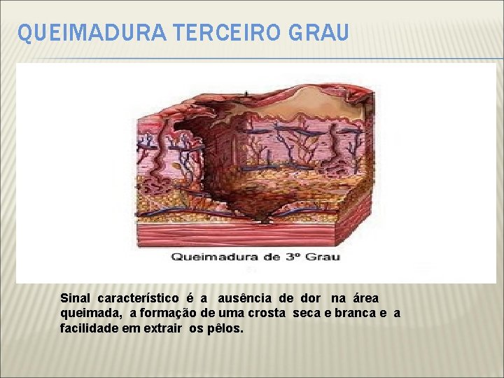QUEIMADURA TERCEIRO GRAU Sinal característico é a ausência de dor na área queimada, a