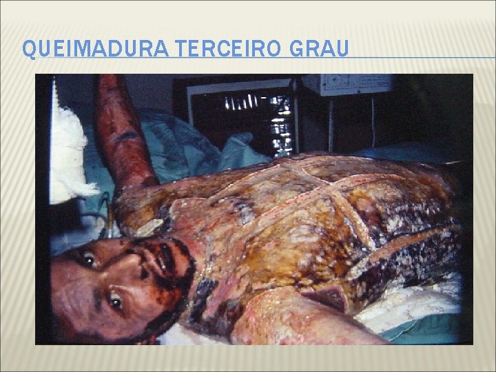 QUEIMADURA TERCEIRO GRAU 