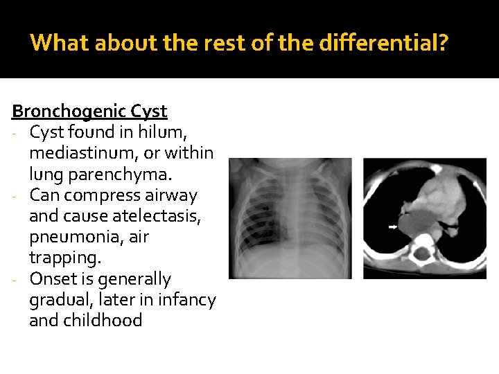 What about the rest of the differential? Bronchogenic Cyst - Cyst found in hilum,