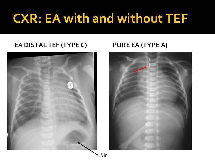 CXR: EA with and without TEF EA DISTAL TEF (TYPE C) PURE EA (TYPE