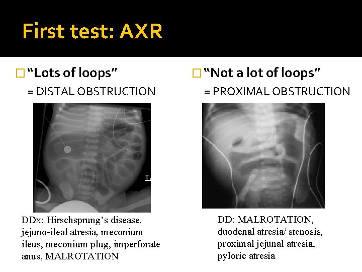 First test: AXR � “Lots of loops” = DISTAL OBSTRUCTION DDx: Hirschsprung’s disease, jejuno-ileal