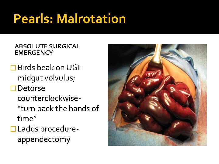 Pearls: Malrotation ABSOLUTE SURGICAL EMERGENCY � Birds beak on UGI- midgut volvulus; � Detorse