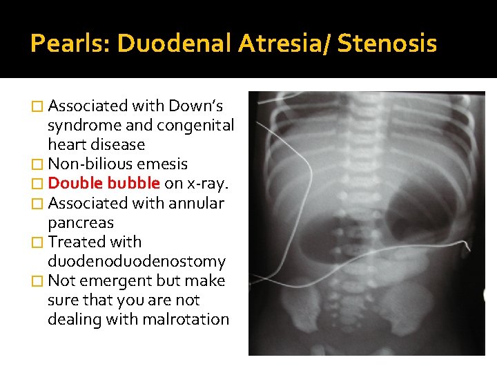 Pearls: Duodenal Atresia/ Stenosis � Associated with Down’s syndrome and congenital heart disease �