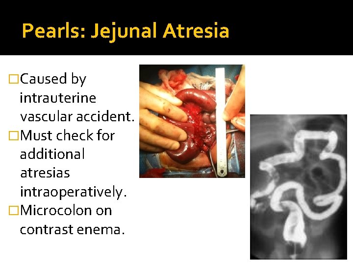 Pearls: Jejunal Atresia �Caused by intrauterine vascular accident. �Must check for additional atresias intraoperatively.