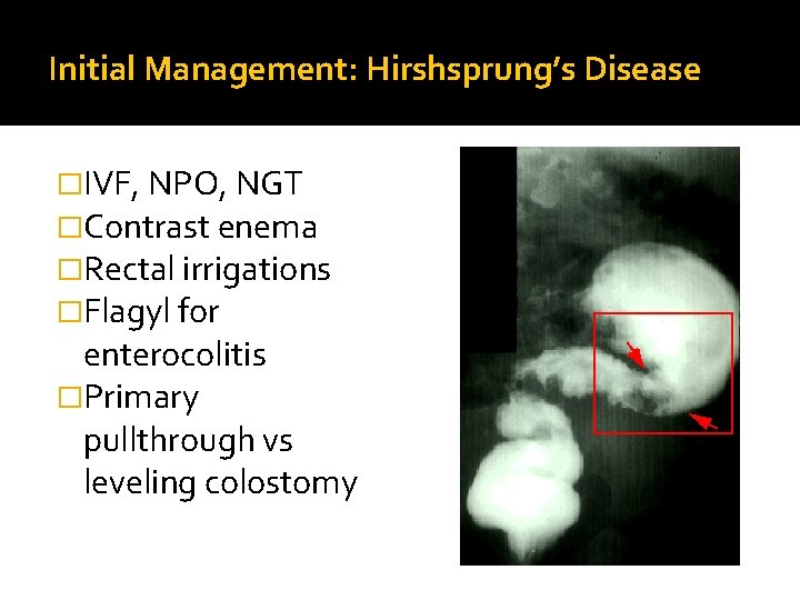 Initial Management: Hirshsprung’s Disease �IVF, NPO, NGT �Contrast enema �Rectal irrigations �Flagyl for enterocolitis