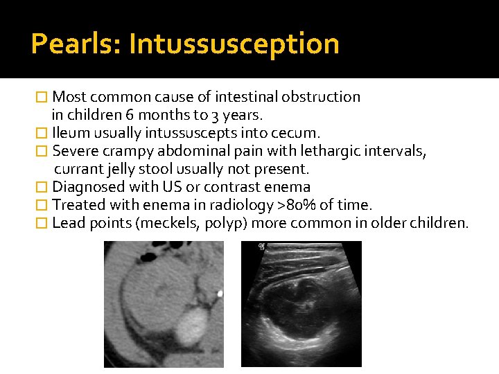 Pearls: Intussusception � Most common cause of intestinal obstruction in children 6 months to