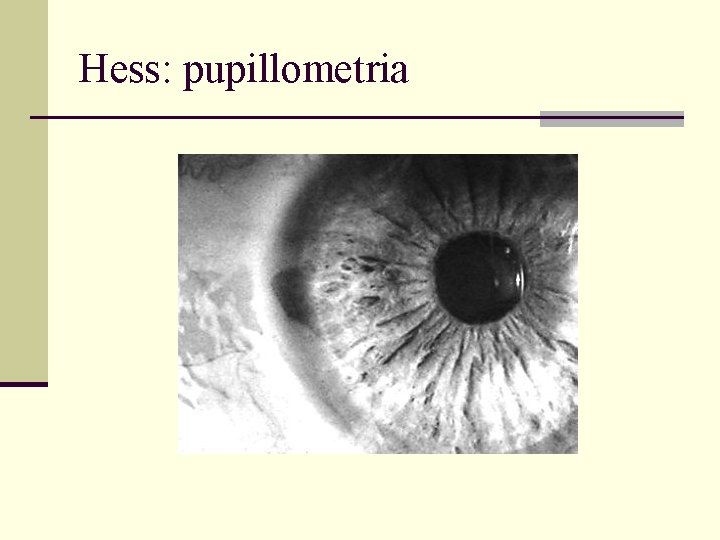 Hess: pupillometria 