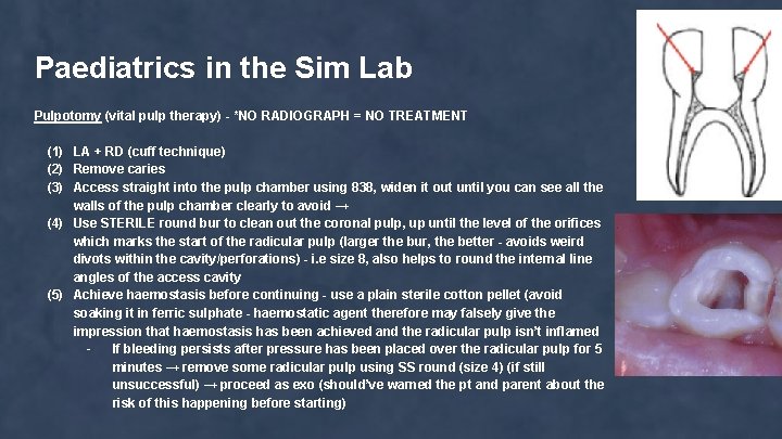 Paediatrics in the Sim Lab Pulpotomy (vital pulp therapy) - *NO RADIOGRAPH = NO