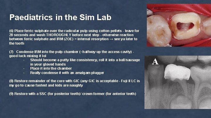 Paediatrics in the Sim Lab (6) Place ferric sulphate over the radicular pulp using