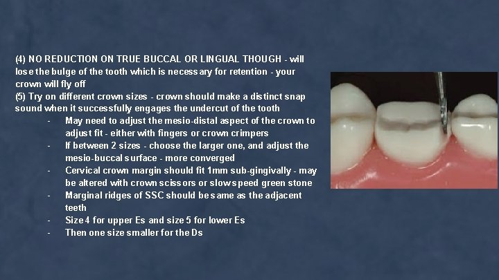 (4) NO REDUCTION ON TRUE BUCCAL OR LINGUAL THOUGH - will lose the bulge