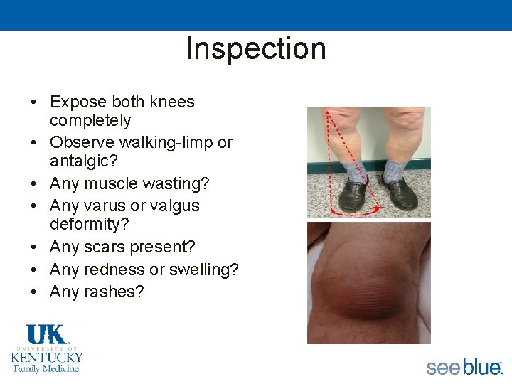 Inspection • Expose both knees completely • Observe walking-limp or antalgic? • Any muscle