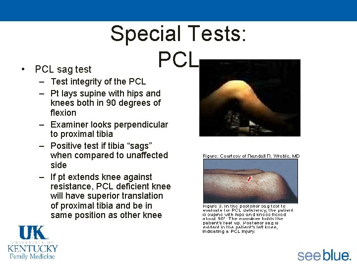  • PCL sag test Special Tests: PCL – Test integrity of the PCL