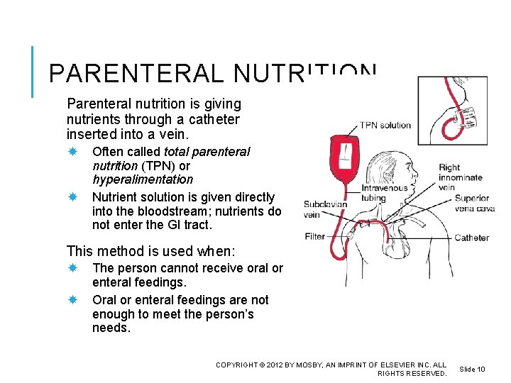 PARENTERAL NUTRITION Parenteral nutrition is giving nutrients through a catheter inserted into a vein.