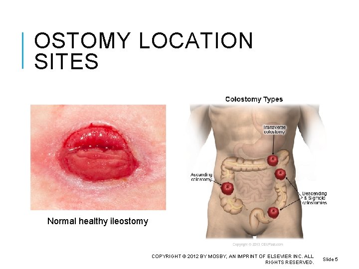 OSTOMY LOCATION SITES Normal healthy ileostomy COPYRIGHT © 2012 BY MOSBY, AN IMPRINT OF