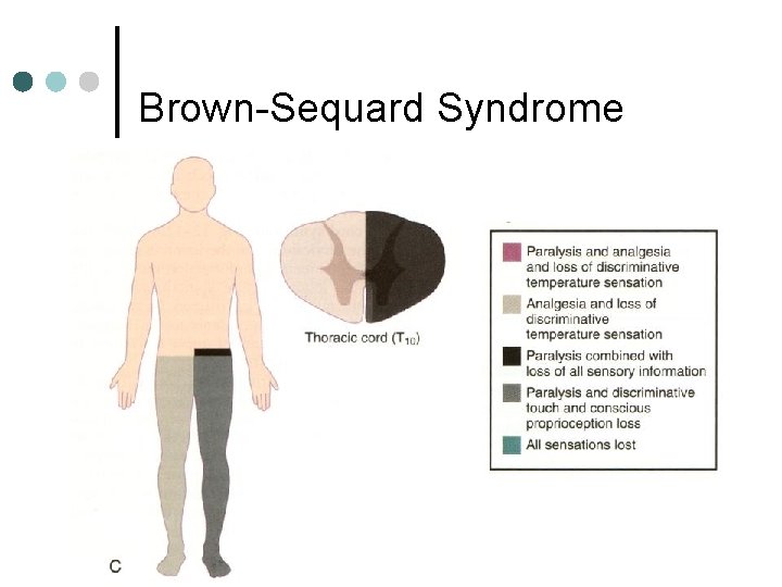 Brown-Sequard Syndrome 
