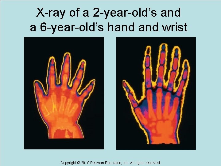 X-ray of a 2 -year-old’s and a 6 -year-old’s hand wrist Copyright © 2010