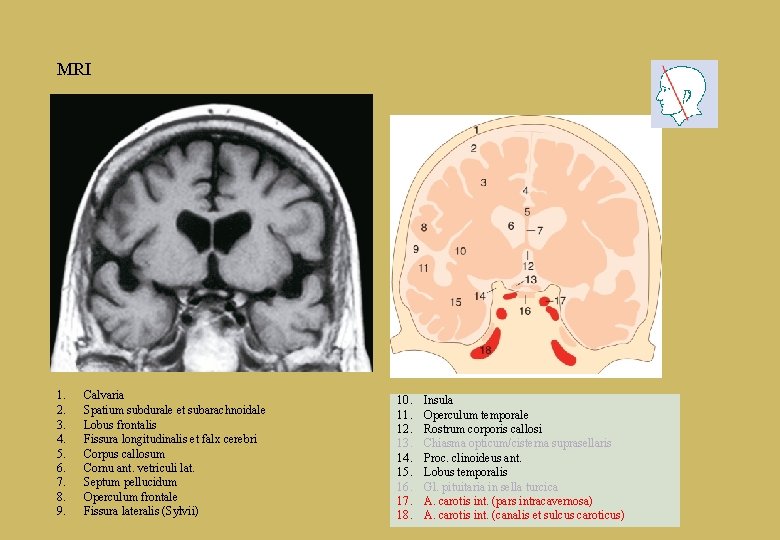 MRI 1. 2. 3. 4. 5. 6. 7. 8. 9. Calvaria Spatium subdurale et