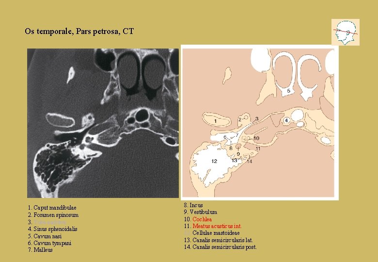 Os temporale, Pars petrosa, CT 1. Caput mandibulae 2. Foramen spinosum 3. Tuba auditiva