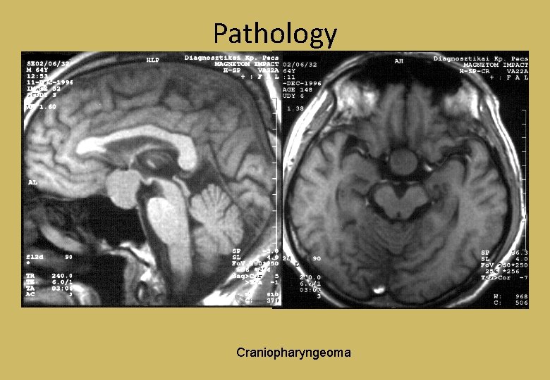 Pathology Craniopharyngeoma 