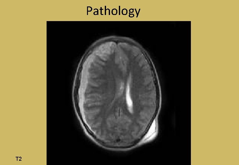 Pathology T 2 