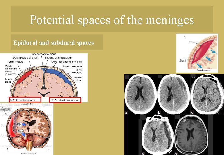 Potential spaces of the meninges Epidural and subdural spaces 