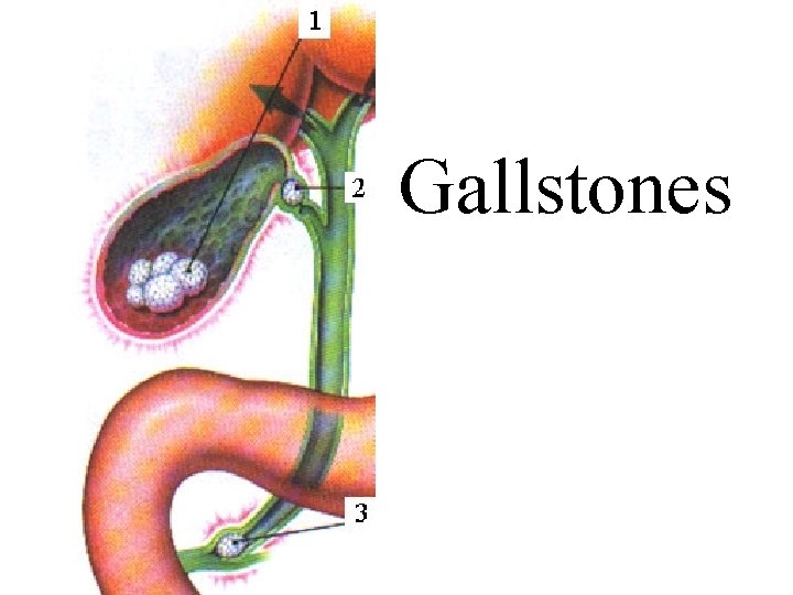 Gallstones 