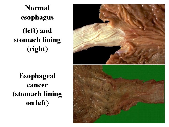 Normal esophagus (left) and stomach lining (right) Esophageal cancer (stomach lining on left) 