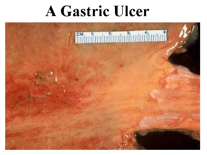 A Gastric Ulcer 