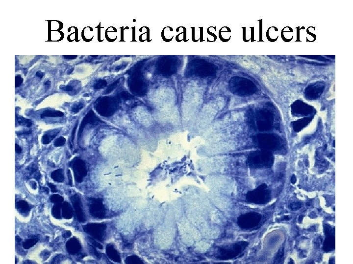 Bacteria cause ulcers 