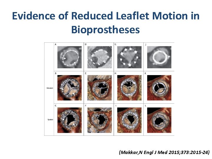 Evidence of Reduced Leaflet Motion in Bioprostheses. Makkar RR et al. N Engl J