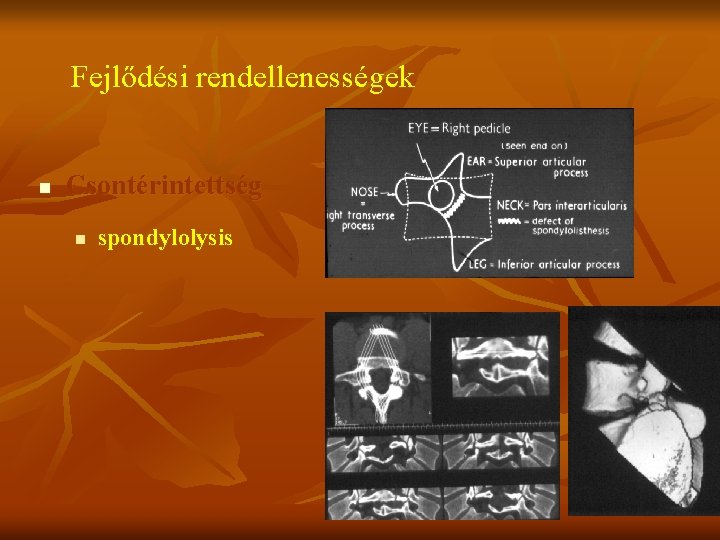 Fejlődési rendellenességek n Csontérintettség n spondylolysis 