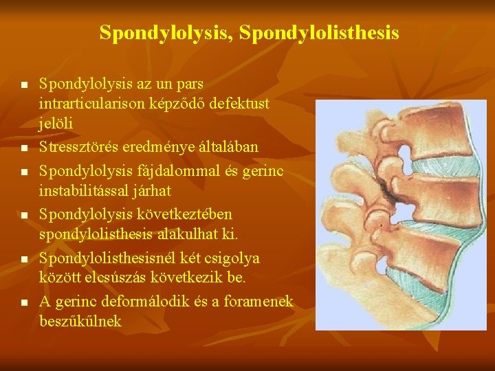 Spondylolysis, Spondylolisthesis n n n Spondylolysis az un pars intrarticularison képződő defektust jelöli Stressztörés