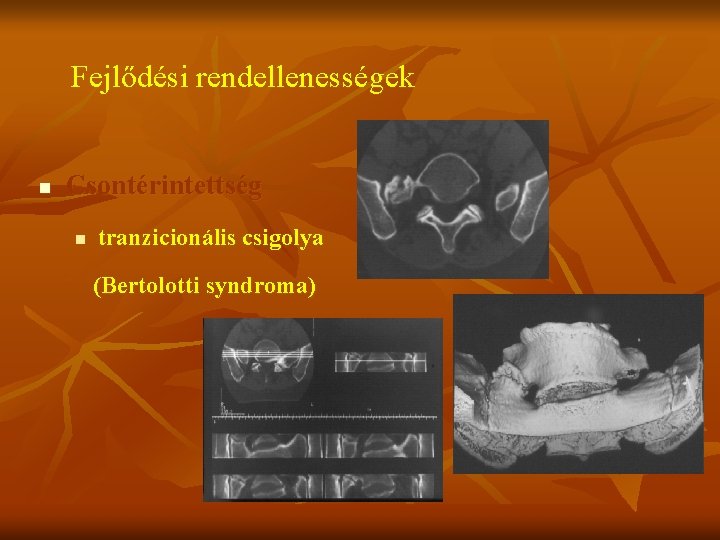 Fejlődési rendellenességek n Csontérintettség n tranzicionális csigolya (Bertolotti syndroma) 