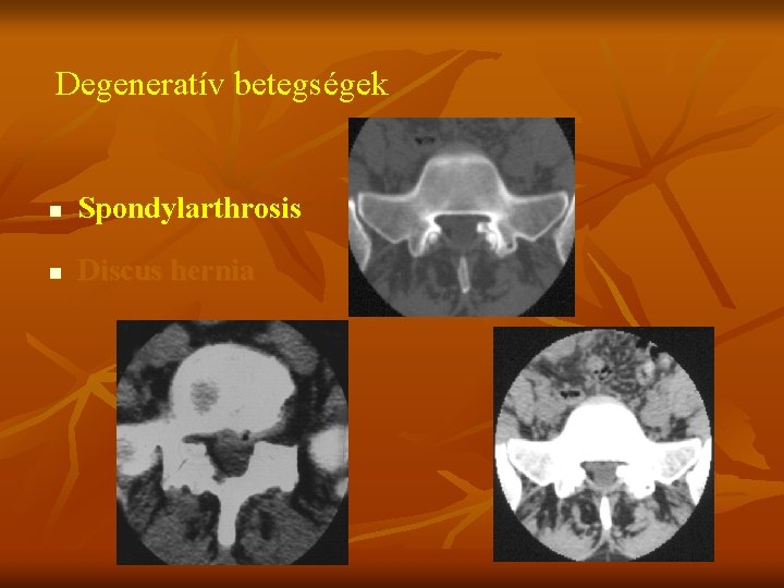 Degeneratív betegségek n Spondylarthrosis n Discus hernia 