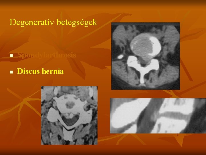 Degeneratív betegségek n Spondylarthrosis n Discus hernia 