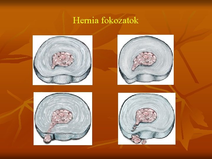 Hernia fokozatok 